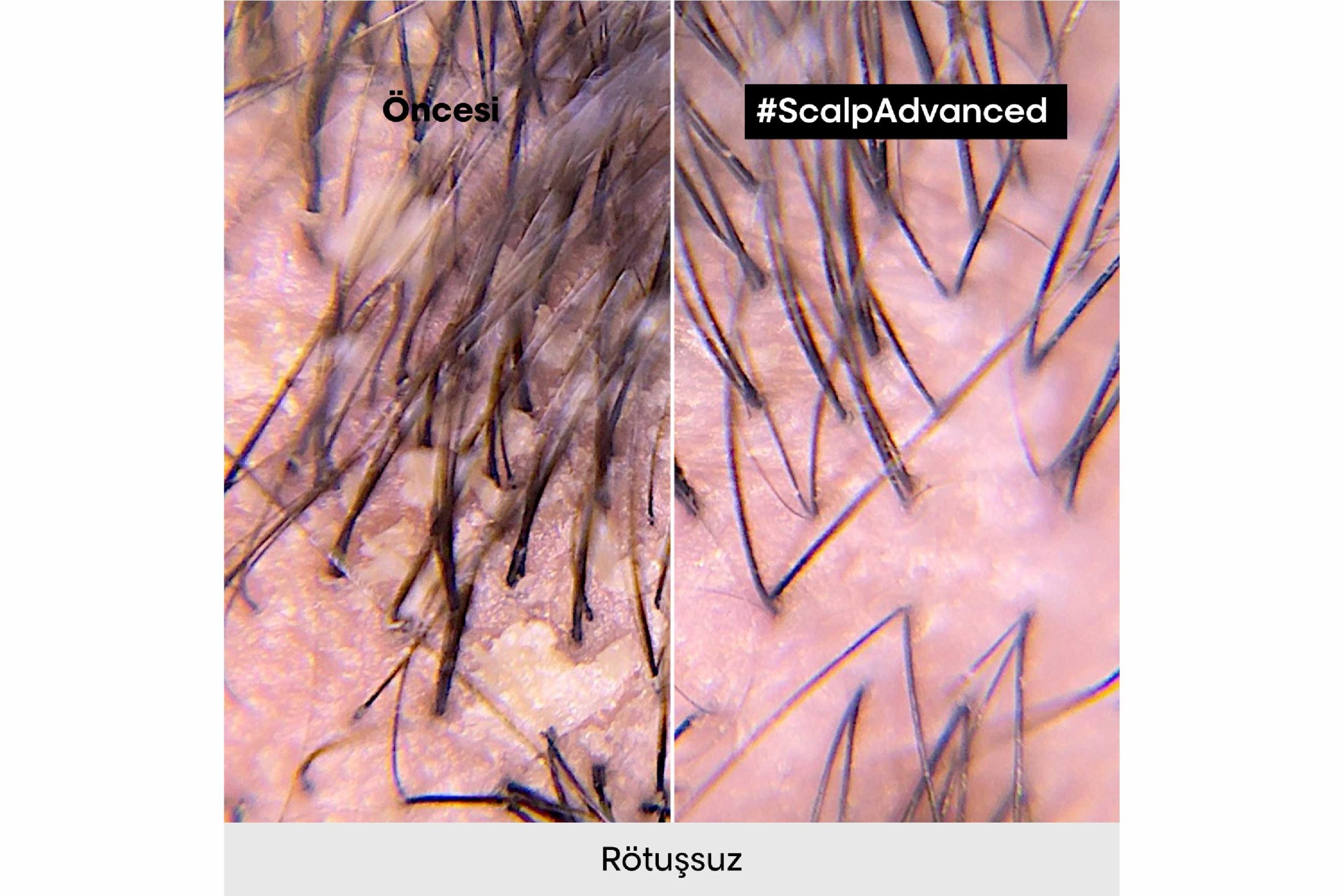 Scalp Advanced Kepek Karşıtı Profesyonel Şampuan 500ml 3 Scalp Advanced Kepek Karşıtı Profesyonel Şampuan 500ml - Görsel 3